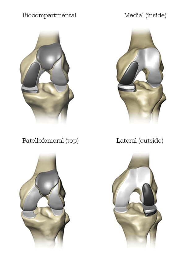 Knee Compartments for partial knee replacement