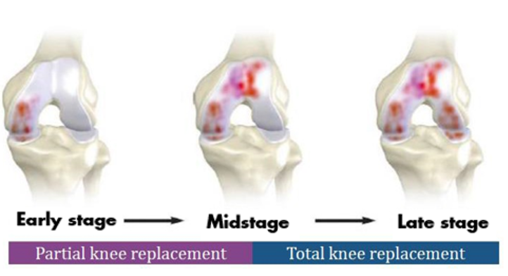 Partial Knee Replacement vs Total Knee Replacement